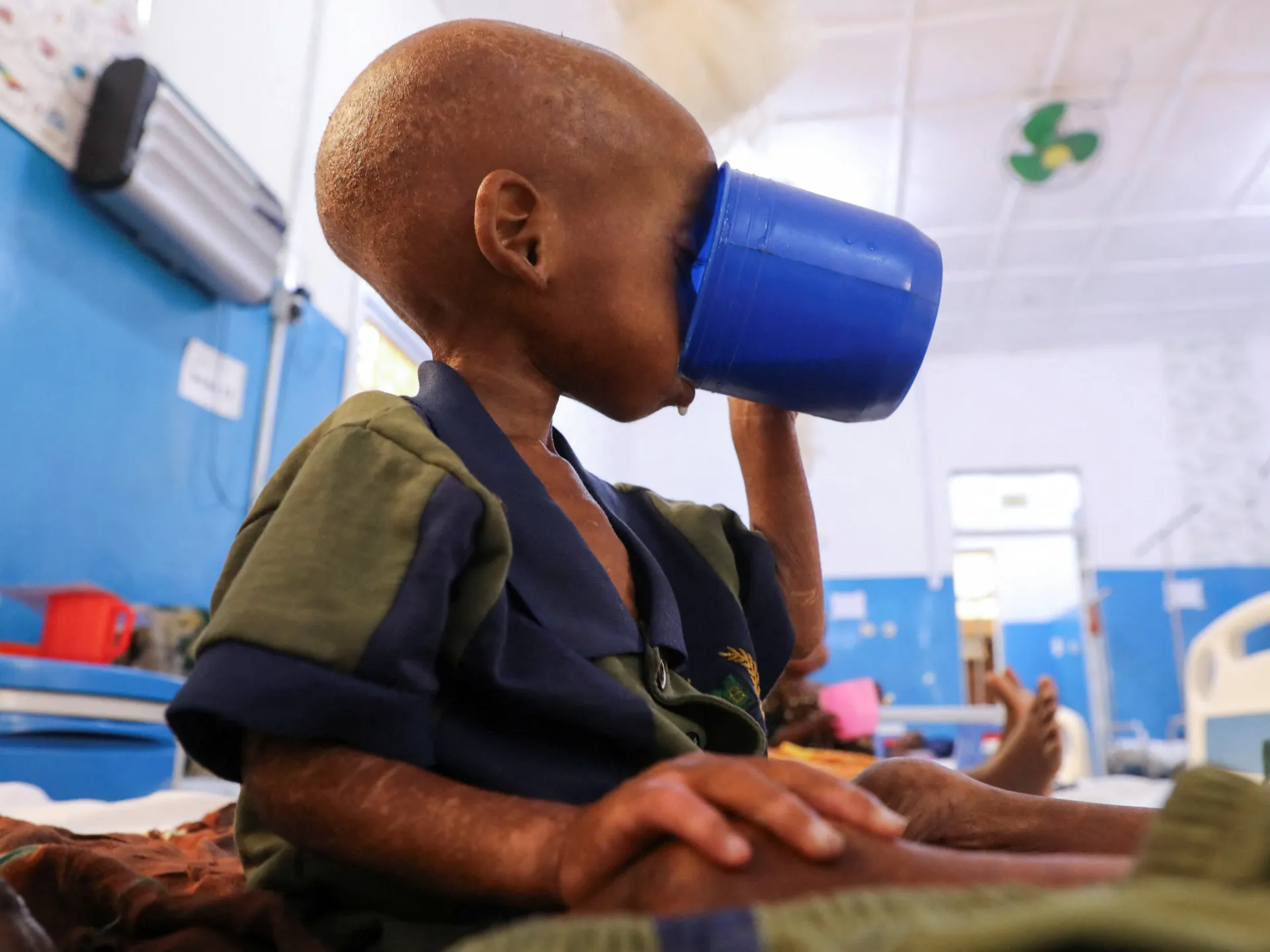 Somalia child hunger crisis deepens after aid cuts, UNICEF says